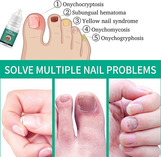 Nexusdrop Nail Treatement Solution