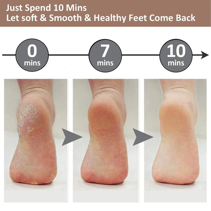 Electric Callus Remover